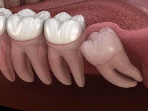 Impacted Tooth Operations